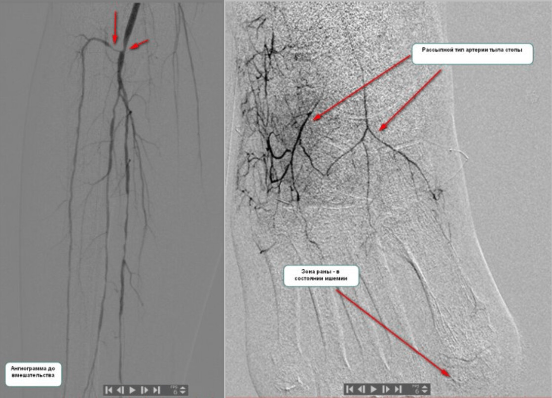 Ангиограмма: рассыпной тип передней большеберцовой артерии