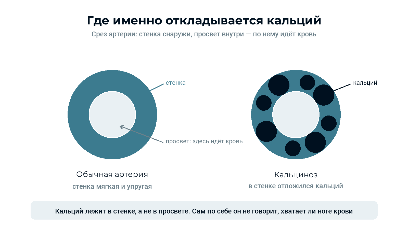 Схема: срез артерии в норме и при кальцинозе — кальций отложился в стенке, просвет свободен