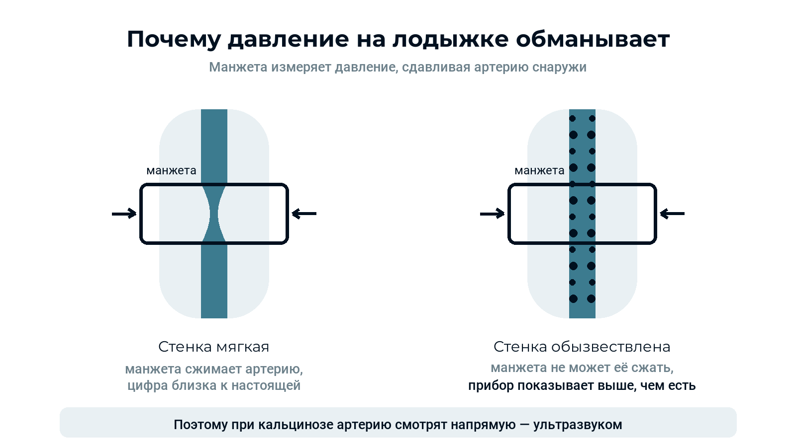 Схема: манжета сжимает мягкую артерию и не может сжать обызвествлённую, поэтому прибор показывает завышенное давление
